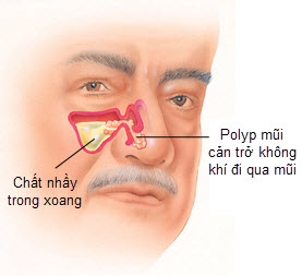 Phân biệt polyp mũi và viêm xoang