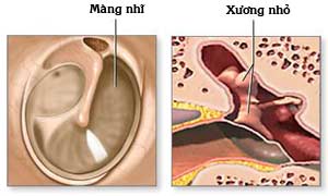 Tai sao màng nhĩ dễ bị tổn thương dẫn đến thủng màng nhĩ ?