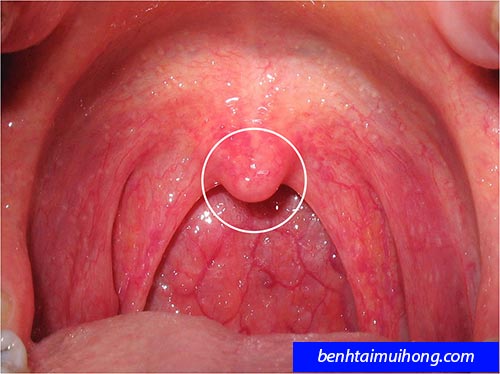 Cách điều trị bệnh viêm amidan triệt để