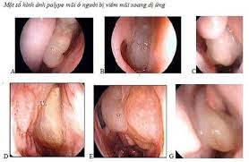 Chuẩn đoán bệnh Polyp mũi