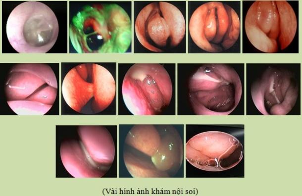 Polyp mũi có nguy hiểm không?