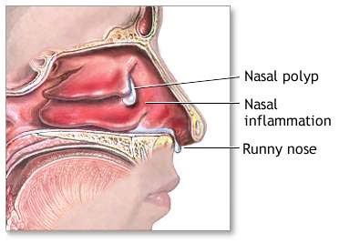 Các mức độ phát triển của polyp mũi