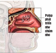 Sự hình thành và triệu chứng bệnh polyp mũi