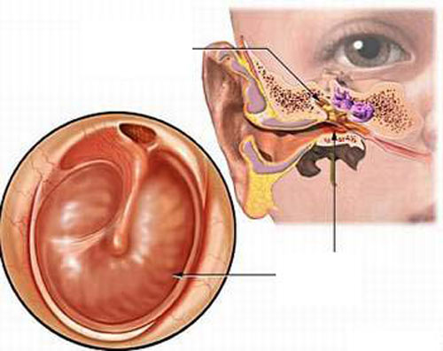 Bị điếc có phải do thủng màng nhĩ