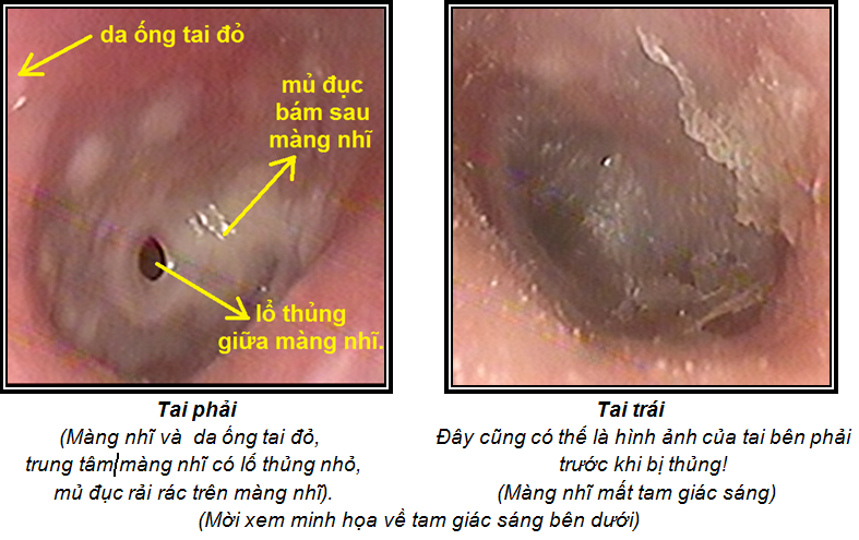 Thủng màng nhĩ có tự liền được không?