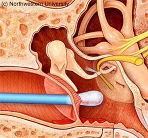 Phương pháp điều chỉnh và thuốc dùng trị bệnh thủng màng nhĩ