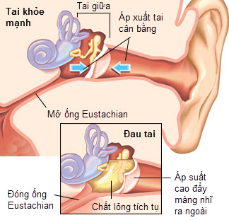 Tổng quan về bệnh viêm tai giữa xương chũm