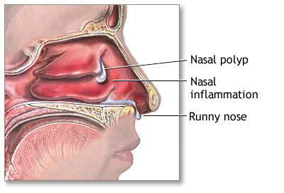 Phẫu thuật bệnh polyp mũi ở đâu?