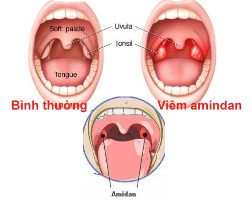 Triệu chứng của bệnh viêm amidan