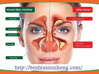 Cách phân biệt bệnh viêm xoang trán và viêm xoang hàm