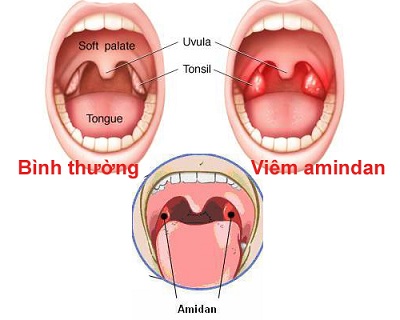 Nguyên nhân gây bệnh viêm amidan thường gặp