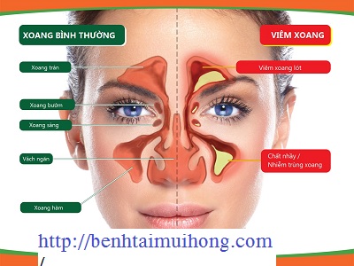 Những điều cần biết về viêm xoang mãn tính