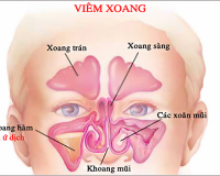 Trieu chung viem xoang biểu hiện như thế nào?