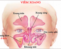 Coi chừng bạn đã có trieu chung cua viem xoang mạn tính