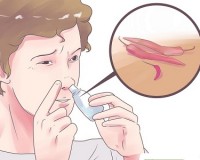 Polyp mui: Biến chứng nguy hiểm và cách phòng ngừa hiệu quả