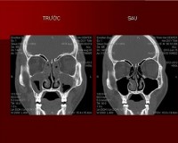 Viêm mũi xoang cấp tính chẩn đoán thế nào đây?