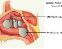 Bạn đã thực sự hiểu về polyp mũi chưa?